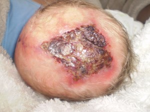 Cutis Aplasia Scalp